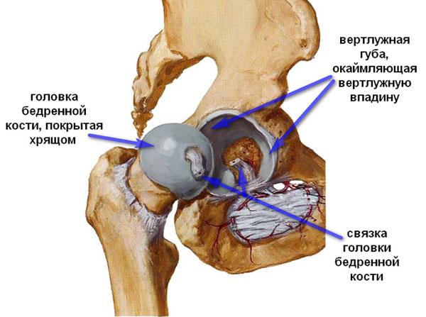 Коксартроз