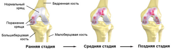 Артрит коленного сустава
