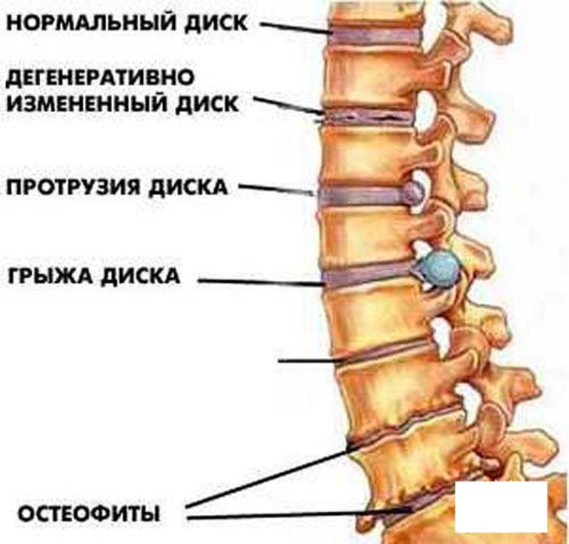 Методы лечения остеохондроза