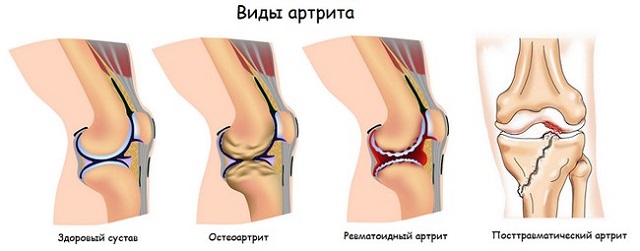 Воспаление суставов