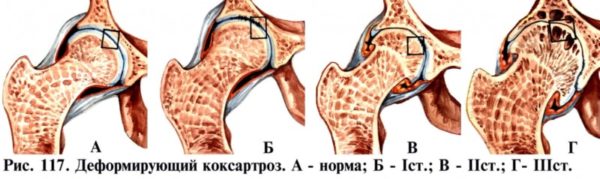Коксартроз