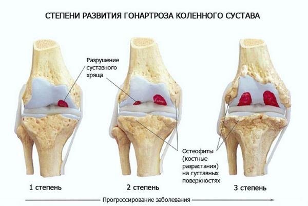 Гонартроз коленного сустава