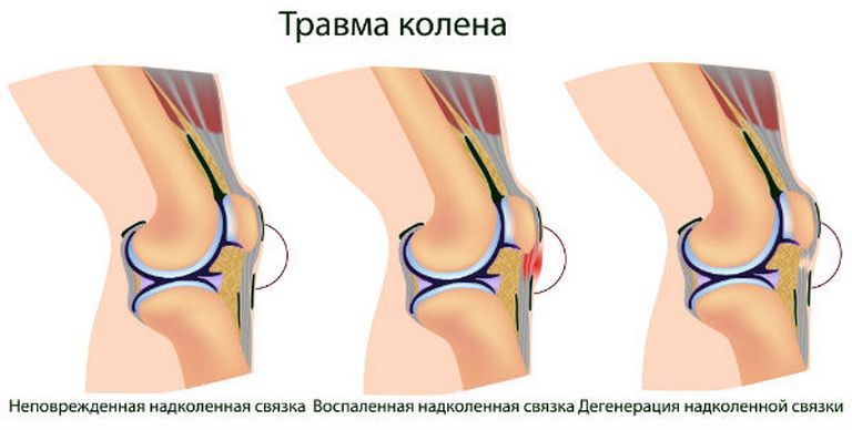 Отек коленного сустава