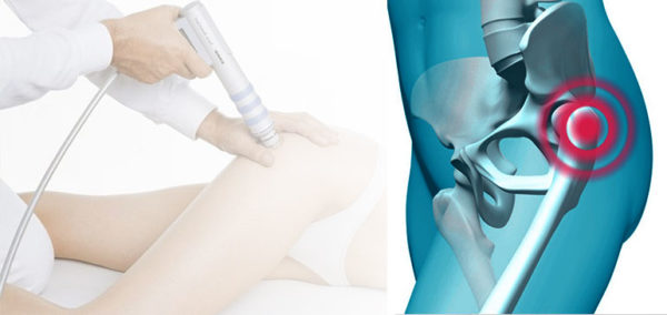 Методы лечения трохантерита тазобедренного сустава Трохантерит тазобедренного сустава