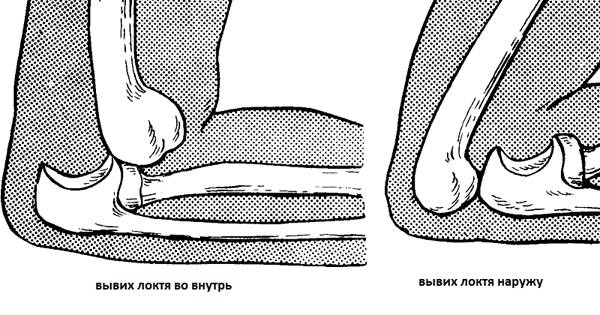 Вывих локтя у ребенка: симптомы