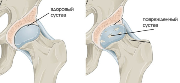 Артрит тазобедренного сустава