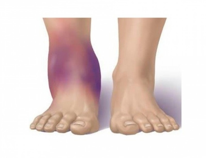 Болят колени при травмировании Боль в колене при травмировании