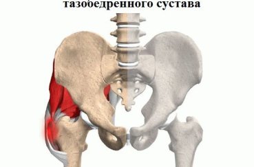 Вертельный бурсит таза