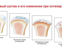 Степени развития болезни