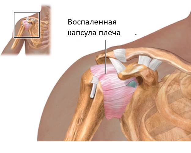 Ноет плечевой сустав при капсулите
