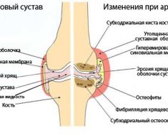 Основные изменения при артрите