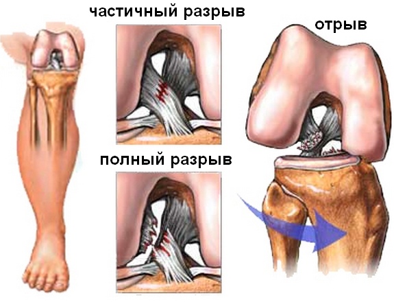 Разрыв связок коленного сустава
