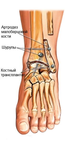 Артродез голеностопного сустава Артродез