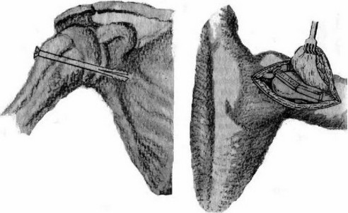 Артродез плечевого сустава Артродез