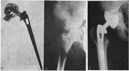 Артродез: показания и противопоказания Артродез