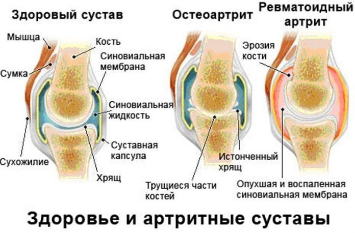 Серонегативный ревматоидный артрит