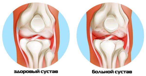 Антибиотики при артрите