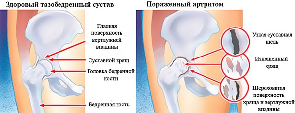 Боль в тазобедренном суставе отдает в ногу