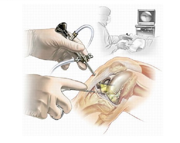 Операции на мениске коленного сустава: артроскопия Операции на мениске коленного сустава