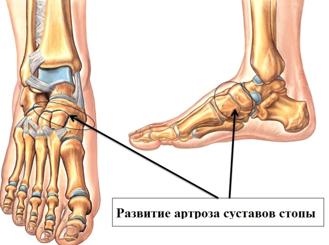Болезни суставов ног
