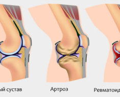 Разные стадии болезни
