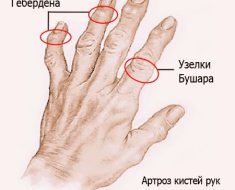 Узелки Бушара и Гебердена