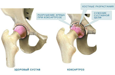 Как выглядит коксоартроз