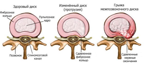 Йога при грыже позвоночника