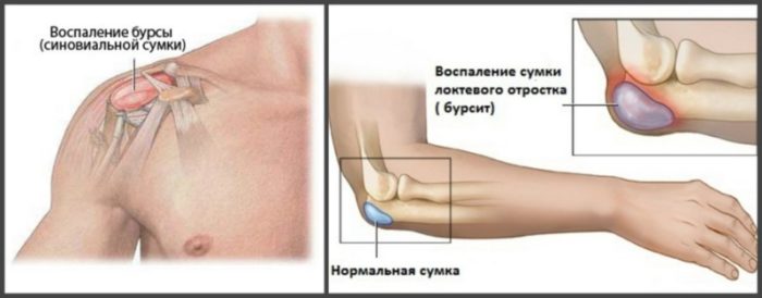 Боль в локте при бурсите