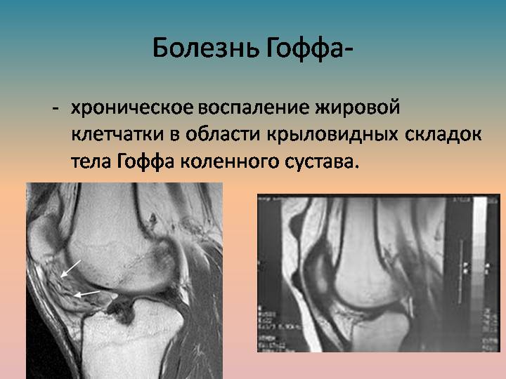 Опухоль под коленом