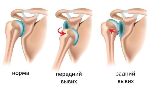 Болит плечо при поднятии руки вверх