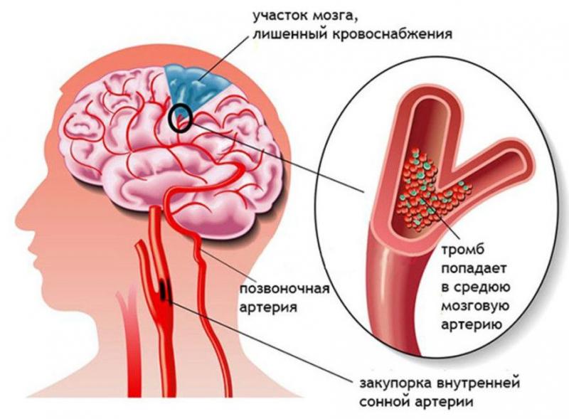 Болит шея и голова