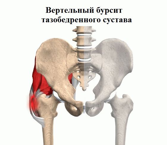 Лечение тазобедренного сустава без операции
