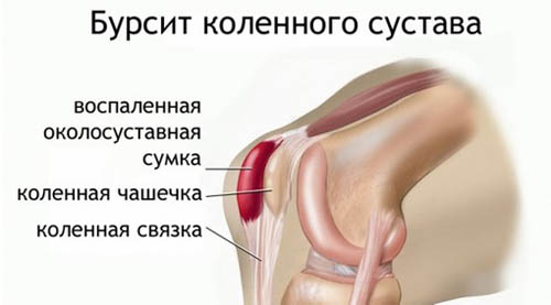 Боль в коленном суставе