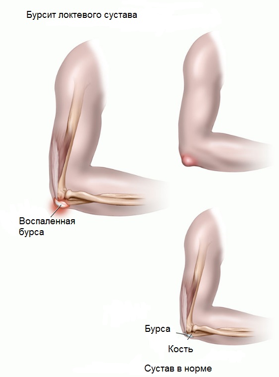 Классификация видов и симптомы бурсита: калькулезный тип Симптомы бурсита