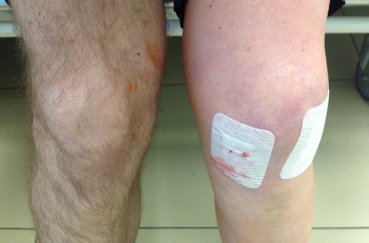 Небольшая припухлость сустава