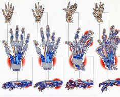 Характерные деформации кистей