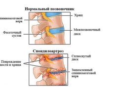 Вид здорового и поврежденного позвоночника