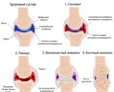 Стадии ревматоидной формы