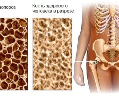 Кости шейки бедра