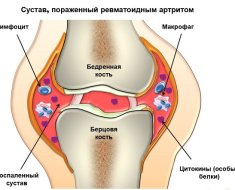 Вид пораженного коленного сустава