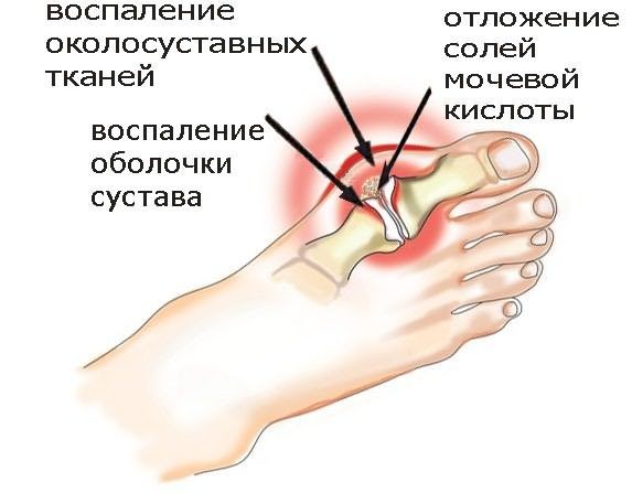 Отложение солей в суставах