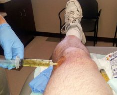 Забор суставной жидкости