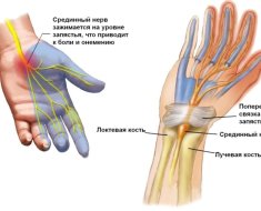 Синдром запястного канала