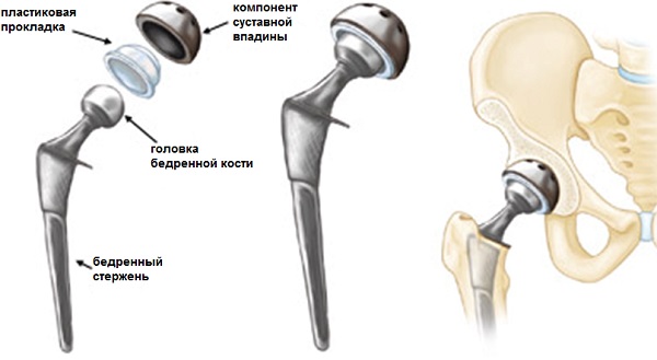Лечение коксартроза
