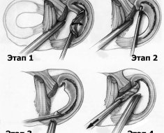 Этапы артроскопической резекции