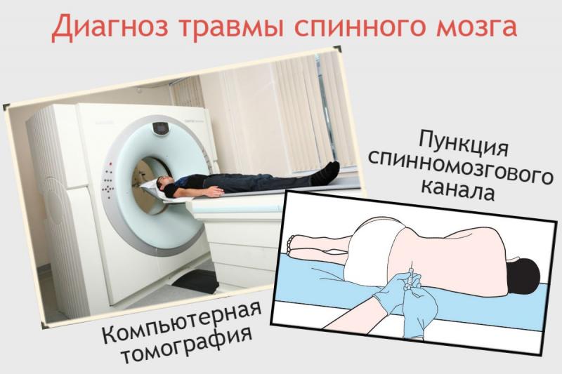 Пункция спинного мозга