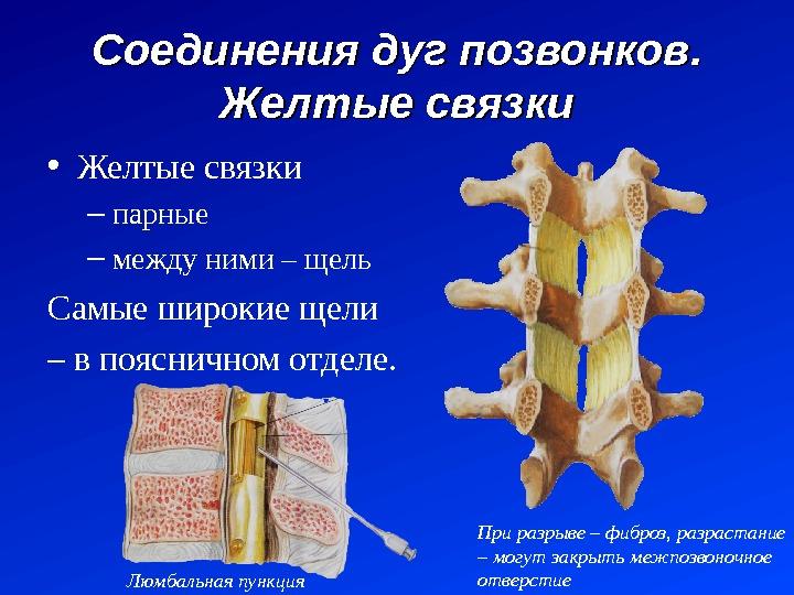 Гипертрофия желтых связок позвоночника