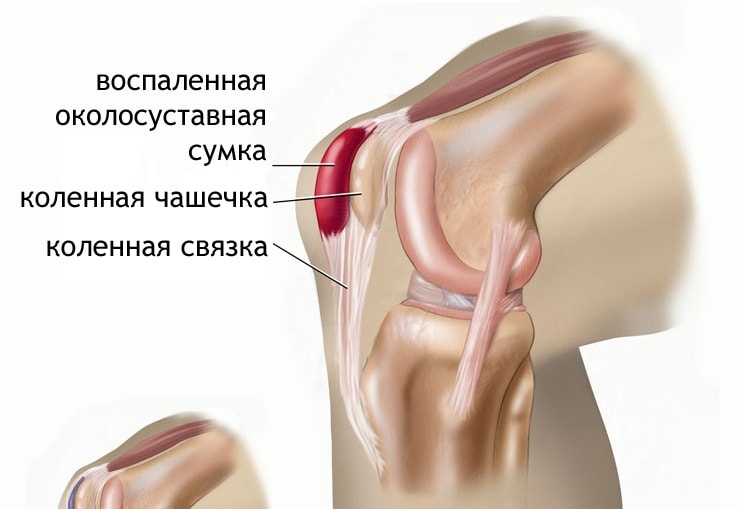 Лекарства от боли в коленях
