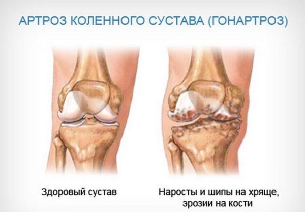Заболевания коленного сустава: гонартроз